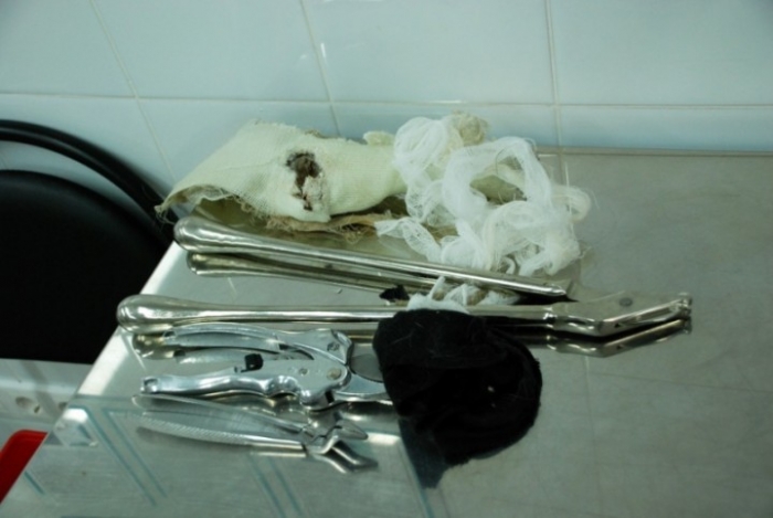 снимаем гипс после месяца...