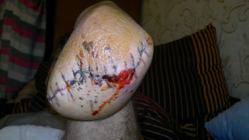 Нога, которую зашили. Без комментариев. Все налицо. Швы разошлись.