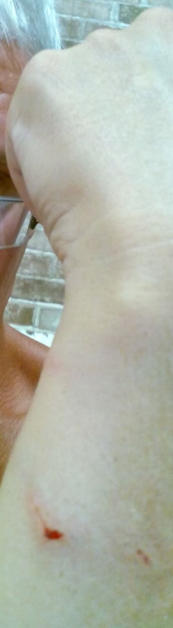 Раны небольшие кажутся на глубокие до кости.  Сильно болела кость.