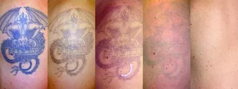 Удаление татуировок лазером