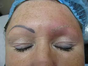 Удаление татуировок лазером