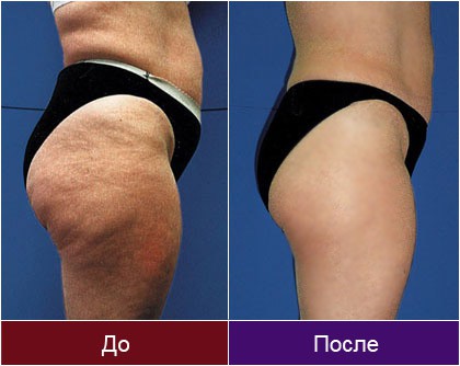 Моделирующий массаж